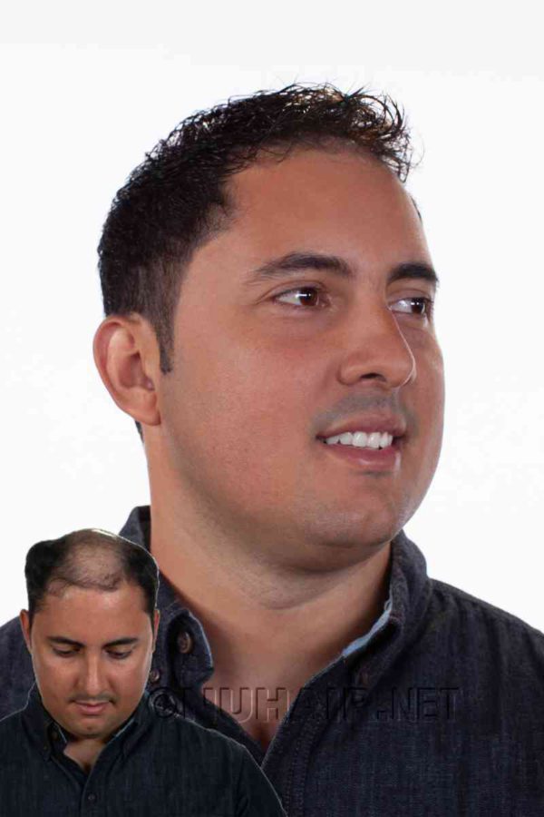 Men Hair Replacement System for Hair Loss Dallas TX