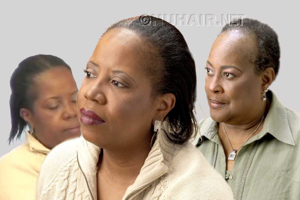 Black Women Hair Loss Due To Hair Extensions Weave Attachment